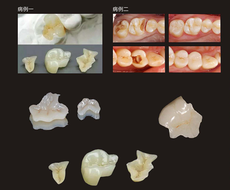 Minimally Invasive Aesthetic Inlay Repair